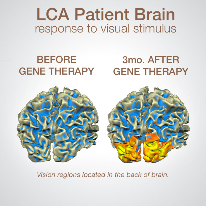 Hereditary Blindness